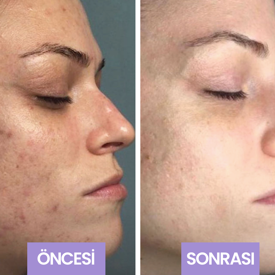 Evol Kayısı Çekirdekli Mikro Granül Peeling Yüz,Batık Peeling